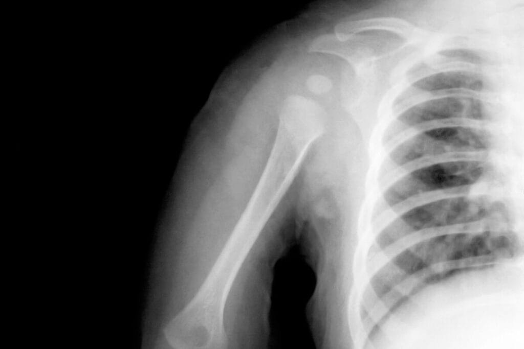 An X-ray scan revealing a child's shoulder injury