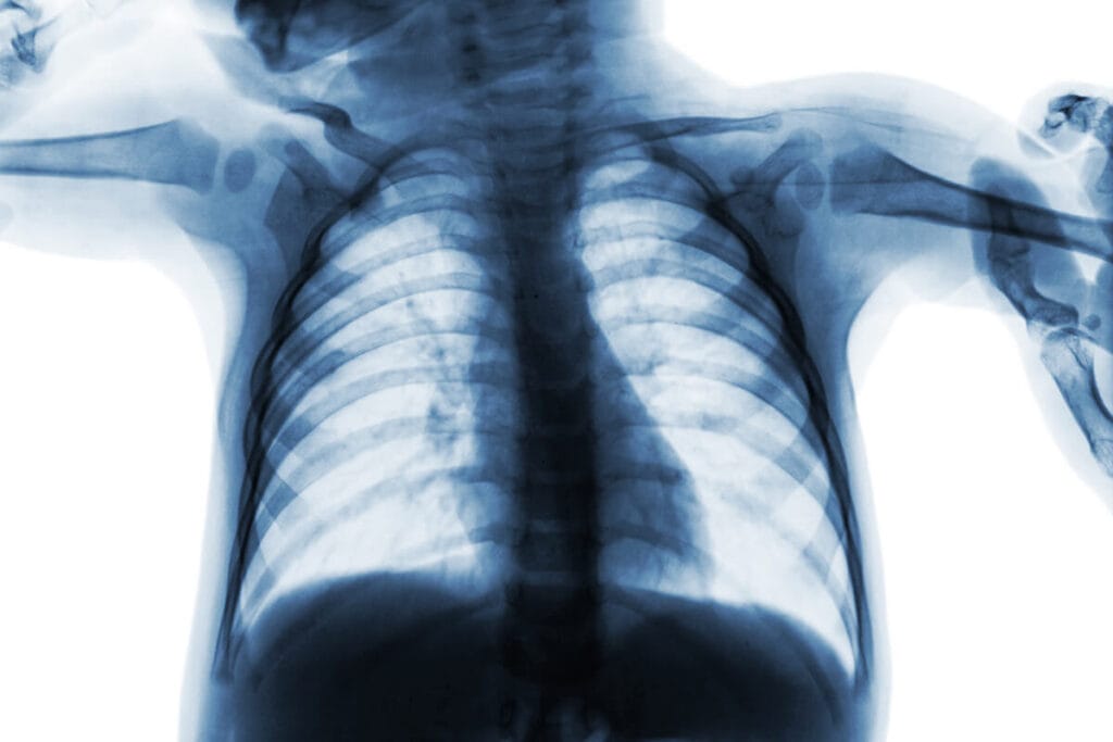 X-ray scan of infant's lungs
