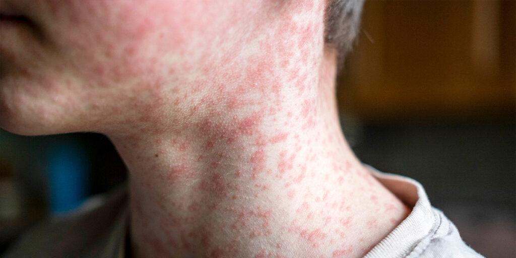 Child with measles on the head and neck