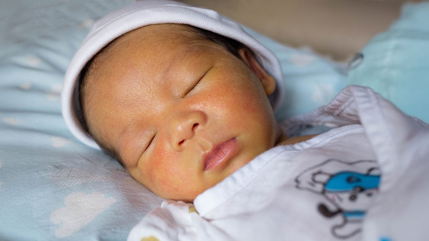 Newborn baby with jaundice
